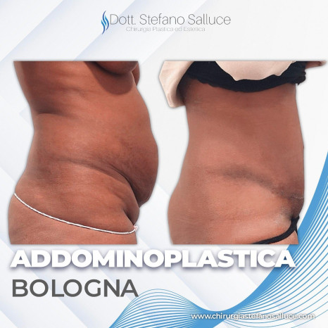 Addominoplastica Bologna Dott. Stefano Salluce